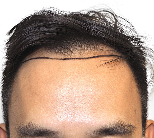 Hair Transplant Long Island Long Island Hair Transplant Center Lihtc 5457