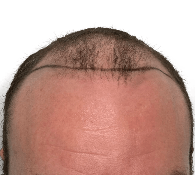 Hair Transplant Long Island Long Island Hair Transplant Center Lihtc 0642