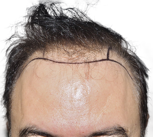 Hair Transplant Long Island Long Island Hair Transplant Center Lihtc 4442